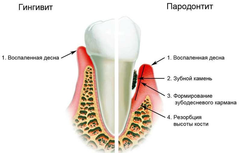 gingivit-i-parodontit