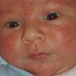Золотуха у детей: причины, симптомы, лечение