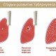 Туберкулез – эпидемиология